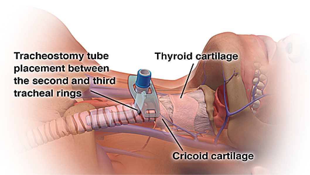 Figure 1. Tracheal Anatomy and Location for Placement of the Tracheostomy Tube.