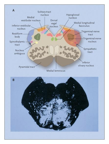 Figure 4. Anatomical Relationships of the Recurrent Laryngeal Nerve.