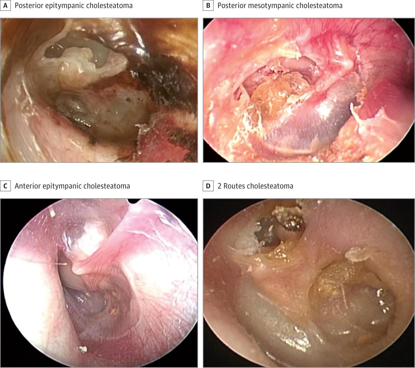 Figure 1. Cholesteatoma Growth Pattern