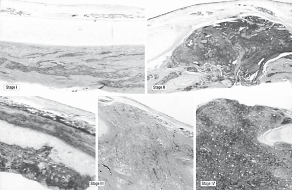 Figure 1. Pathogenesis of Mucormycosis, Host Defenses, and Potential Future Therapeutic Targets.