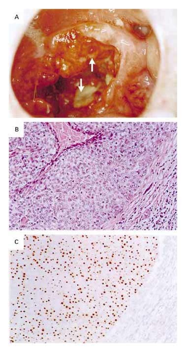 Figure 2. Human Papillomavirus (HPV) in Oropharyngeal Cancers.