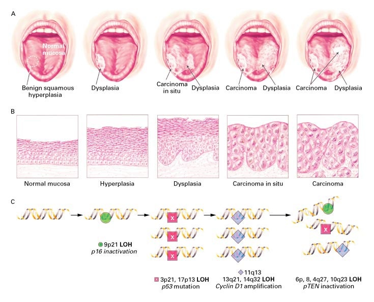 Figure 1. Clinical, Pathological, and Molecular Progression of Oral Cancer.