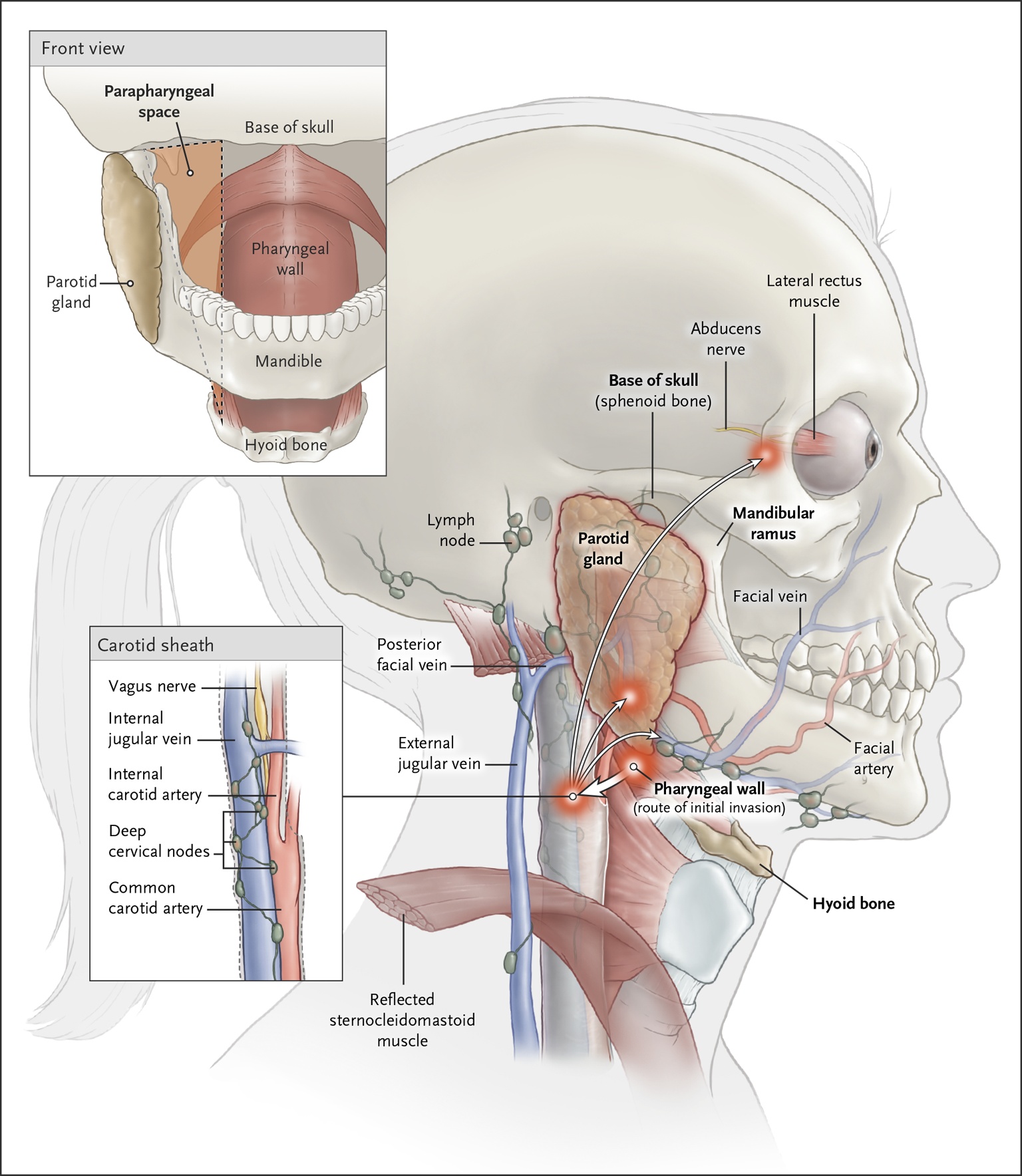 Figure 3. Anatomical Features of Laterally Invasive Pharyngeal Infection.
