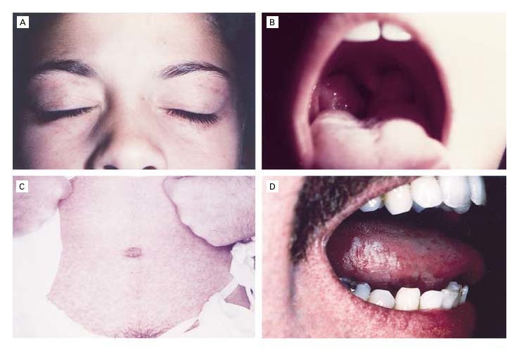 Figure 3. Clinical Findings in Epstein–Barr Virus (EBV) Infection.