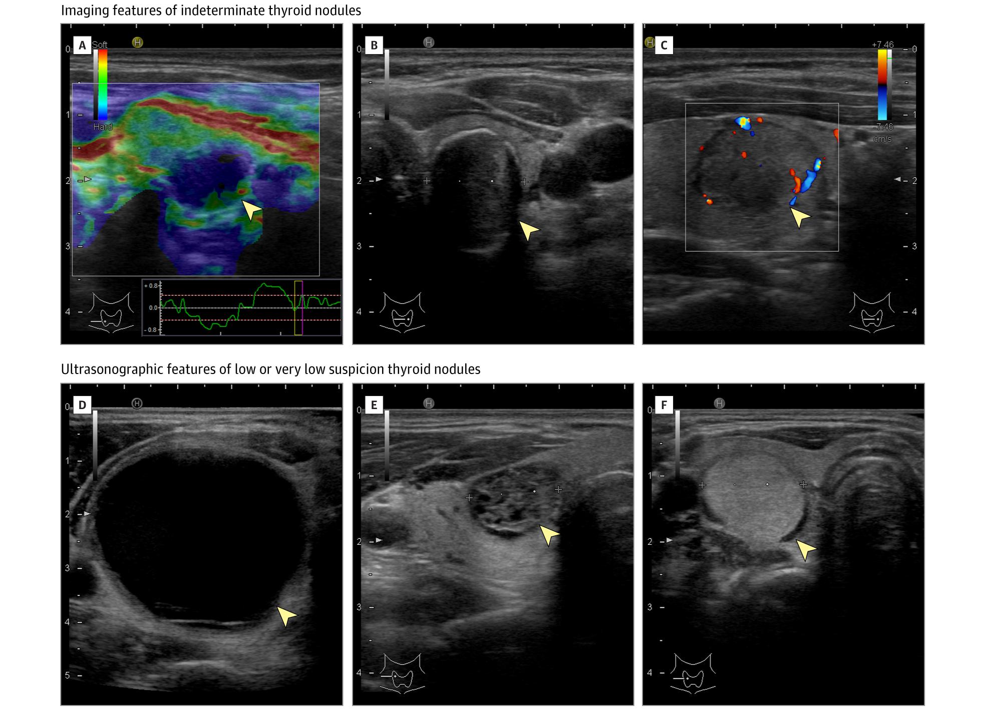 Figure 1. Pathologic Spectrum of Thyroid Cancers.