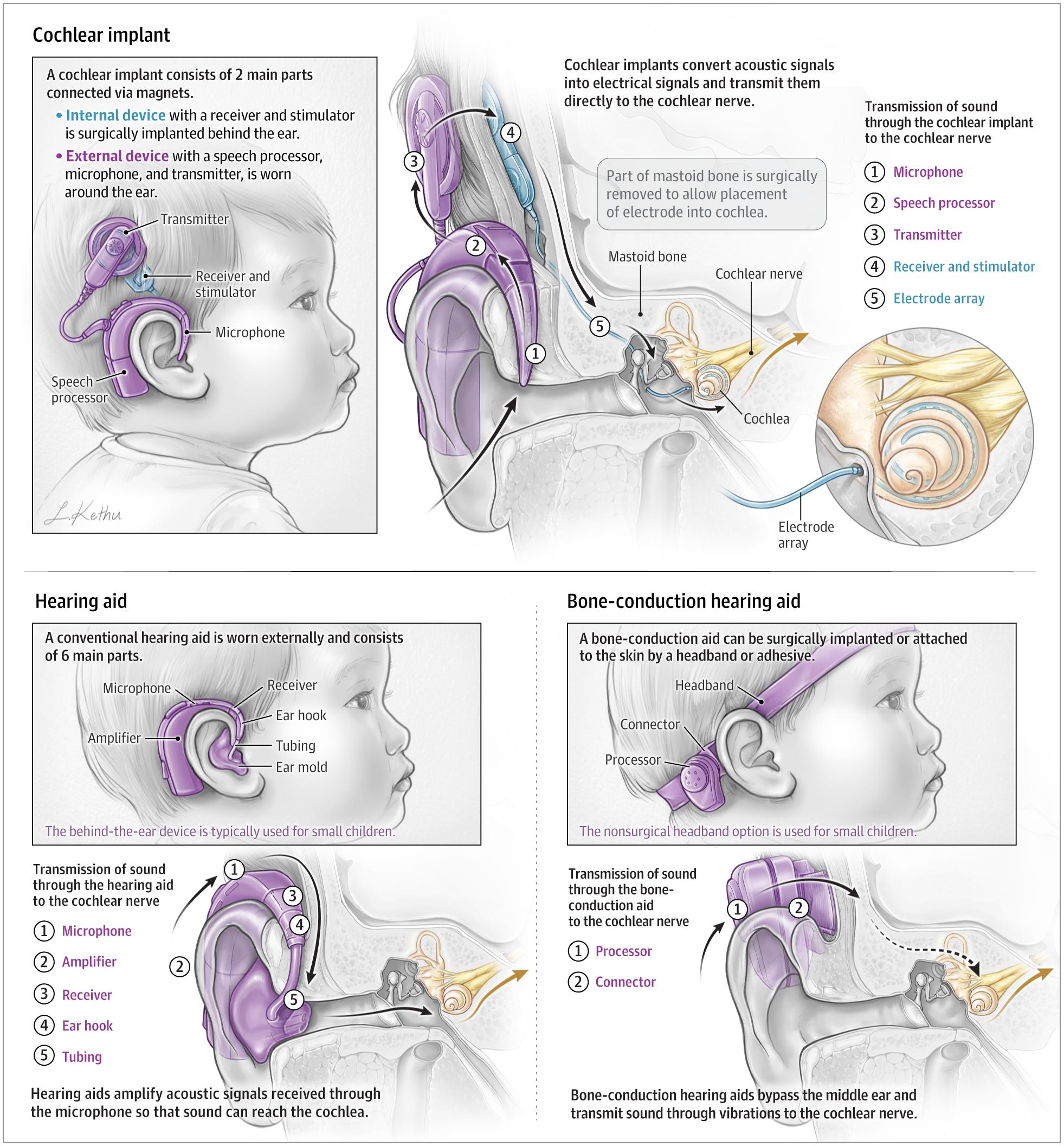 Figure 1. Cochlear Implant vs Hearing Aid