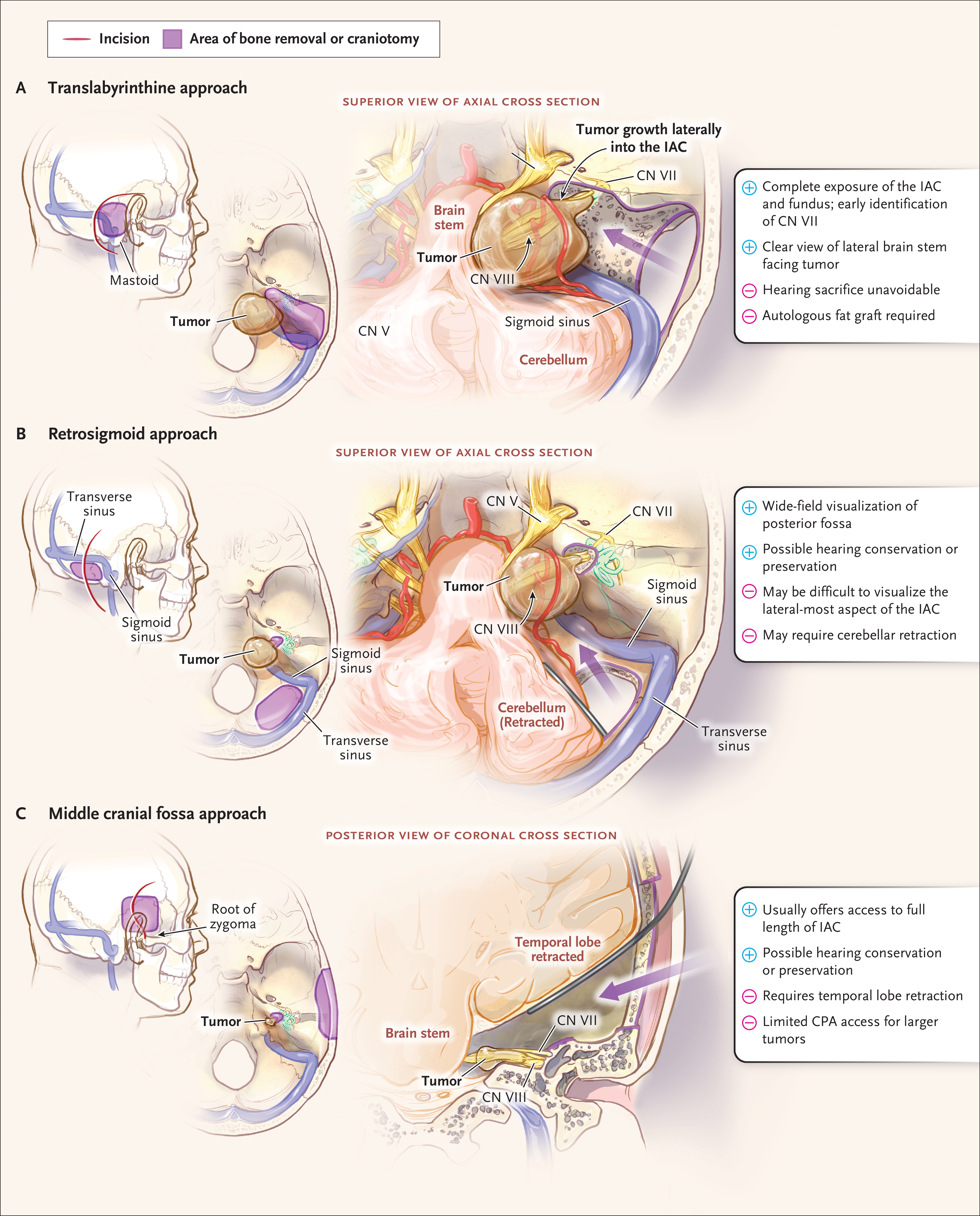 Figure 5. Microsurgical Approaches for the Treatment of Vestibular Schwannomas.